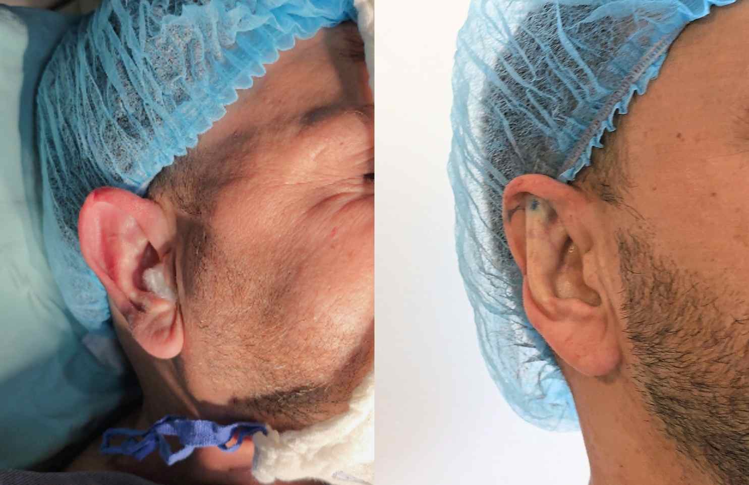 Antes y Después de la otoplastia