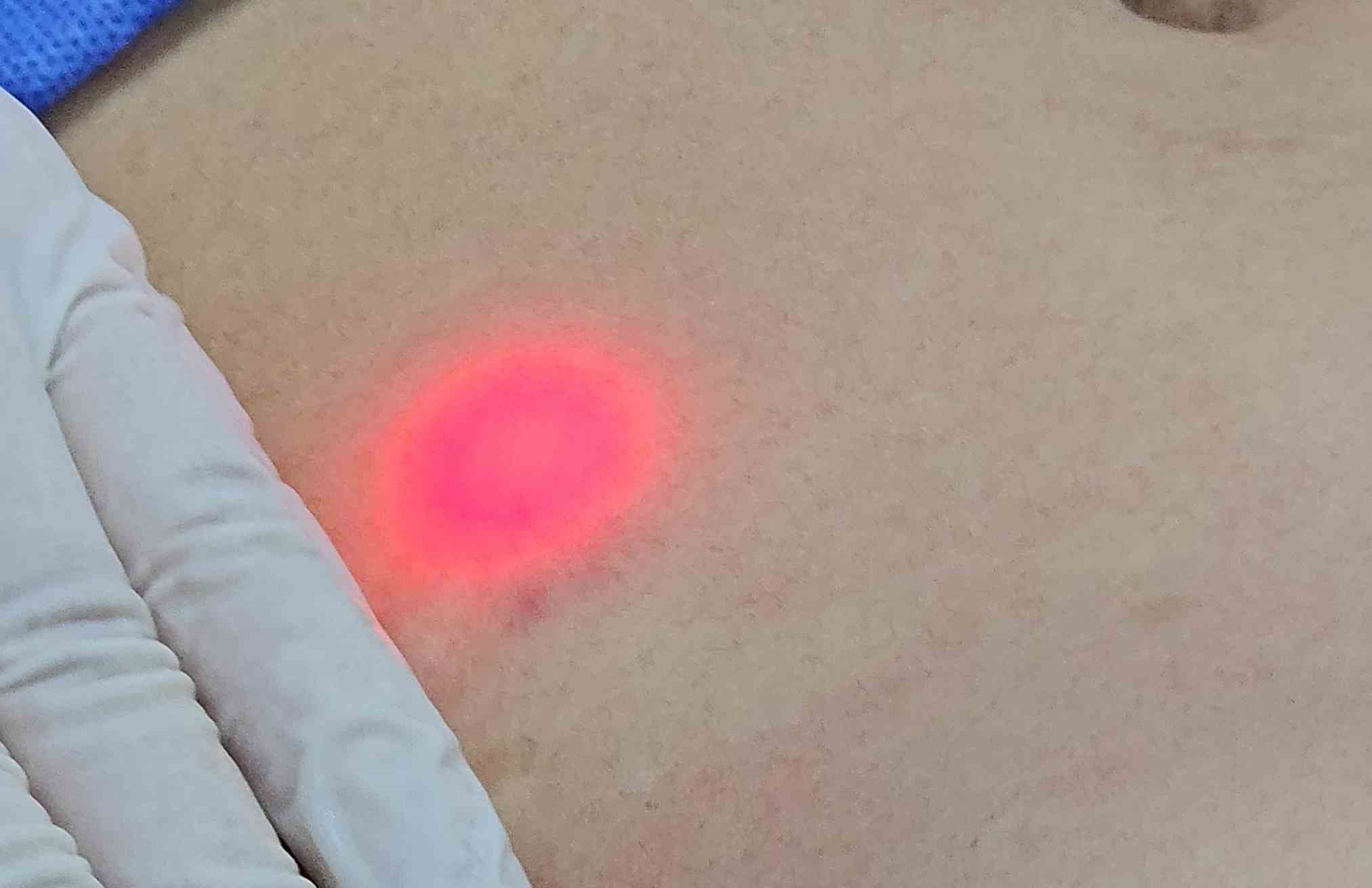 beneficios del endolifting laser