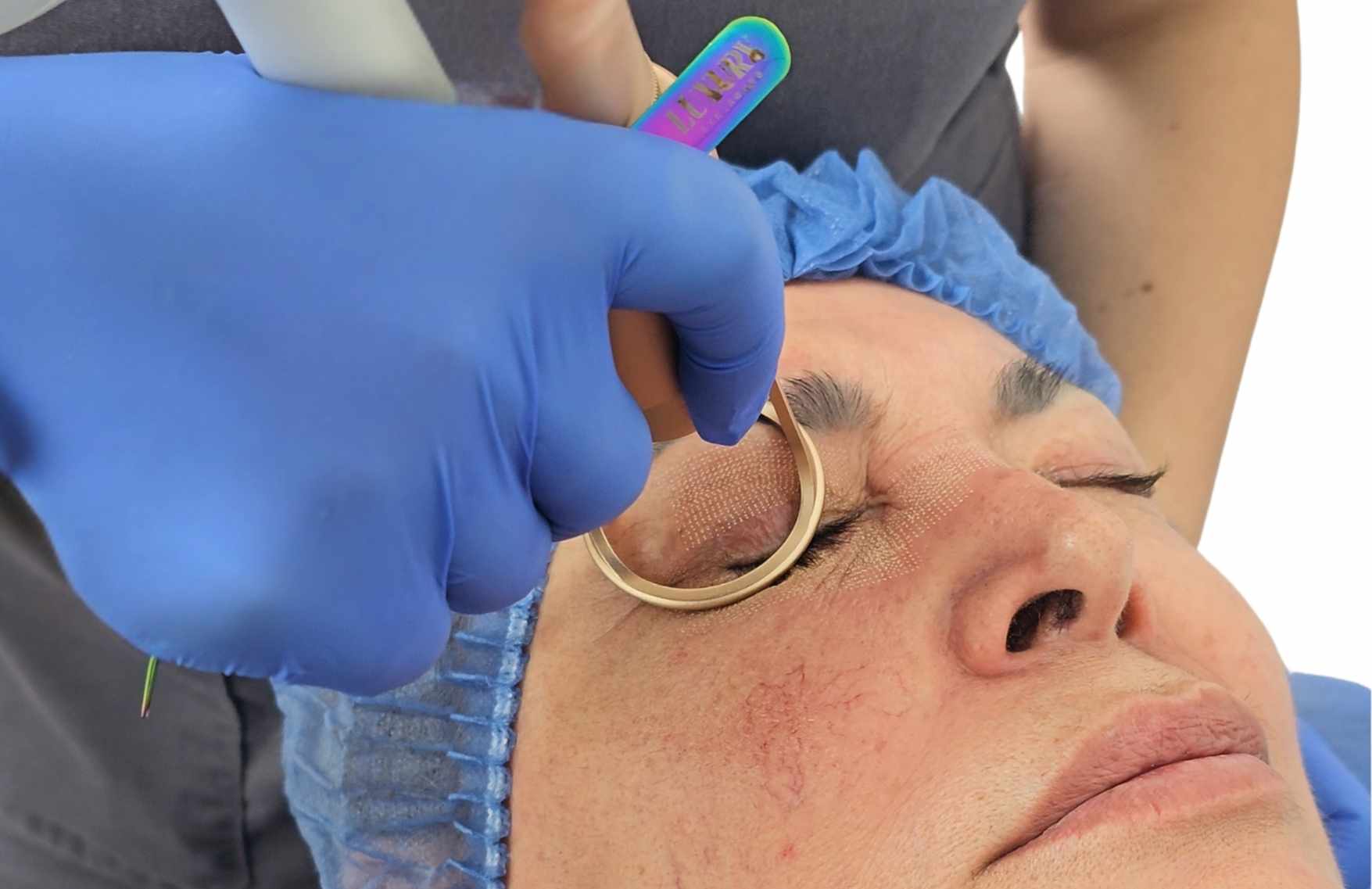 blefaroplastia laser