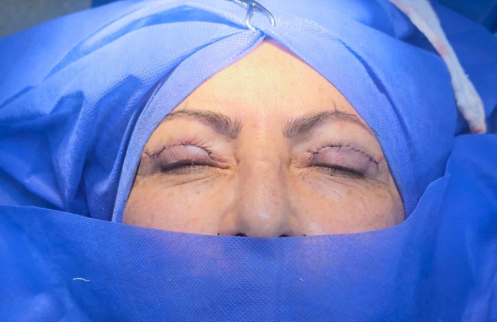 blefaroplastia quirurgica