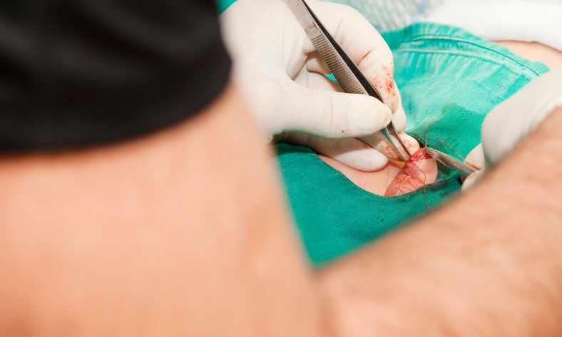 cirugia circuncision