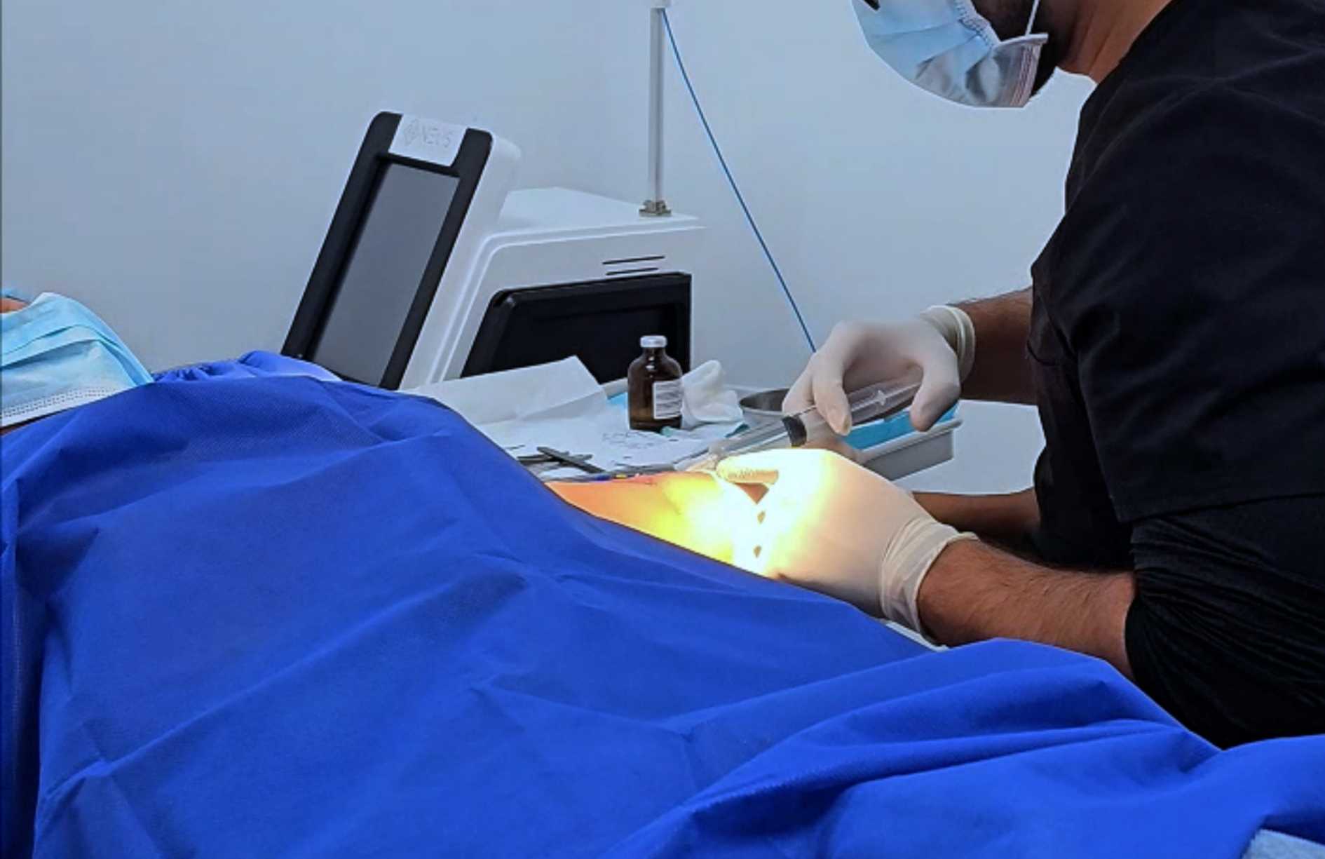 cirugia para quitar queloides