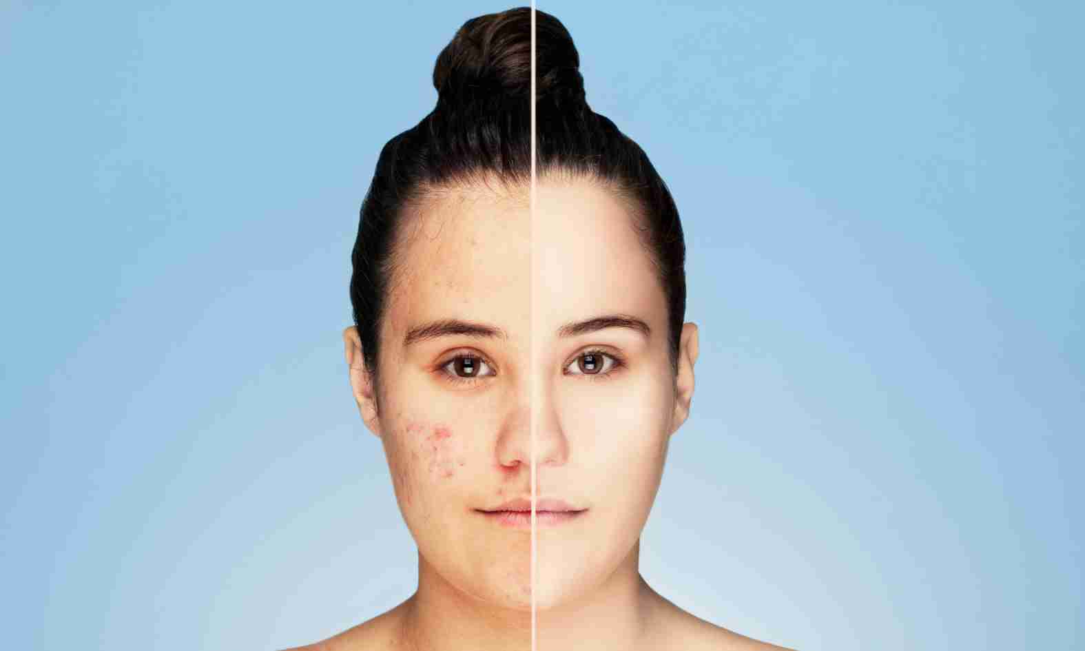 como controlar el acne