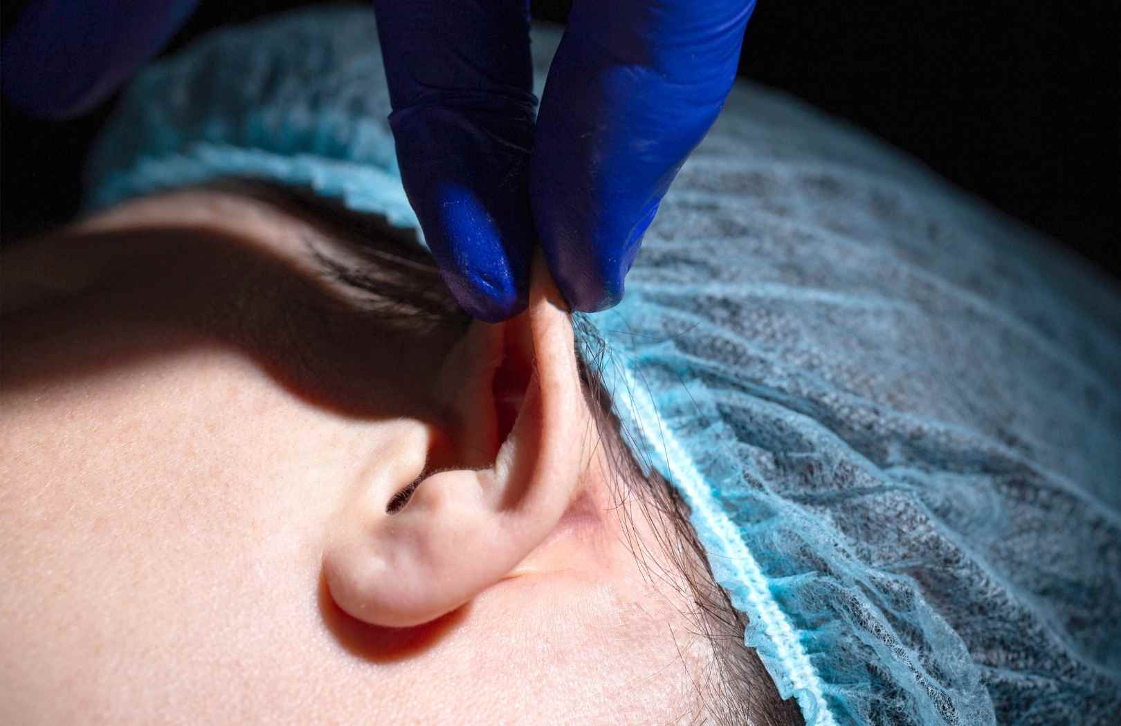 como es la cirugia de otoplastia