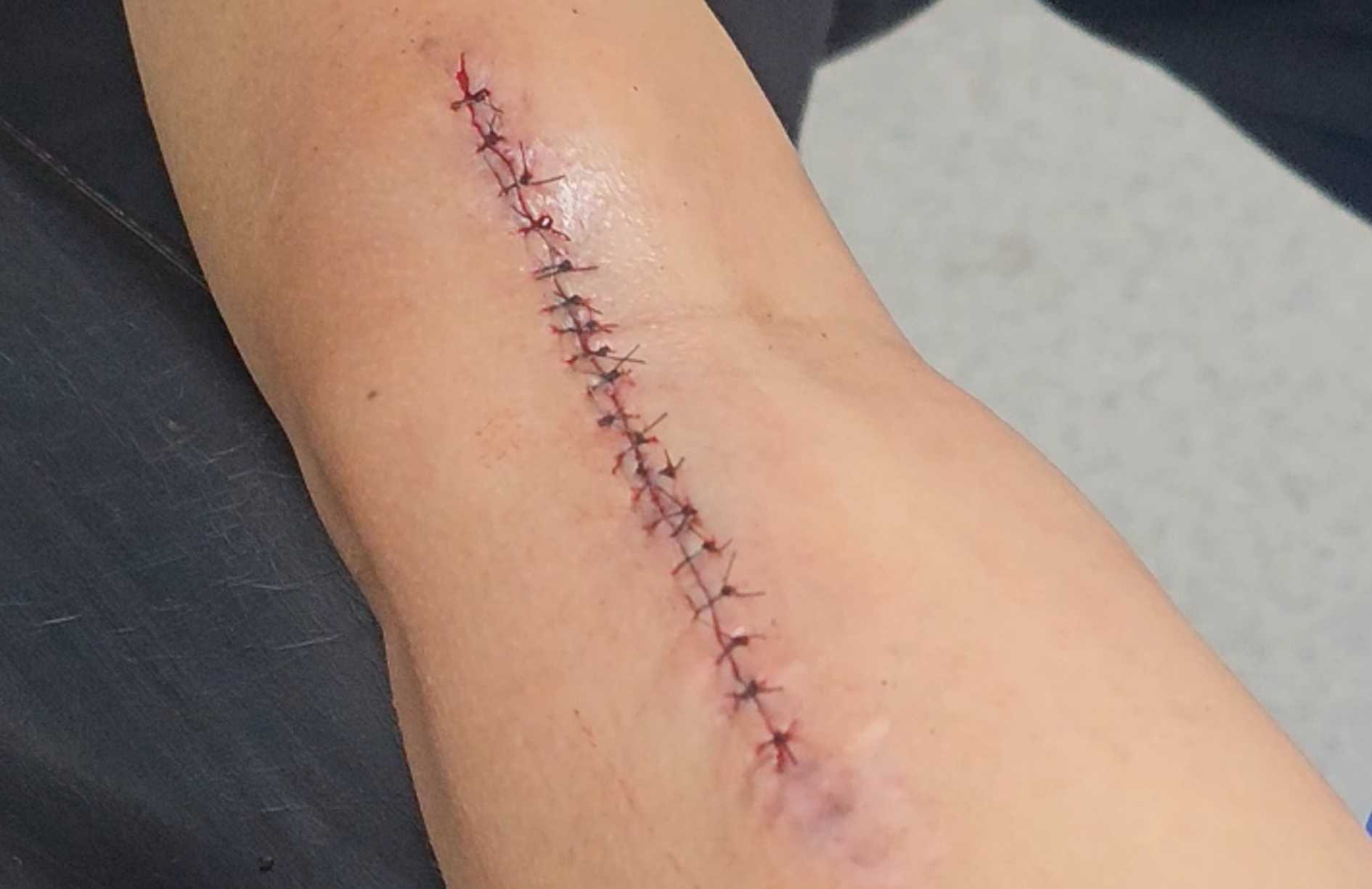 como queda la cicatriz queloide luego de retirar