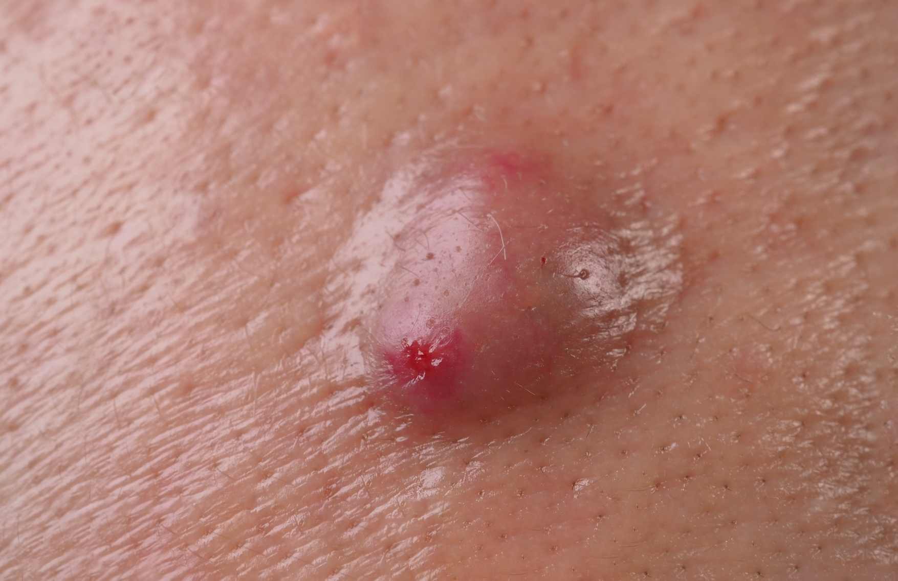 como se cura un absceso cutaneo