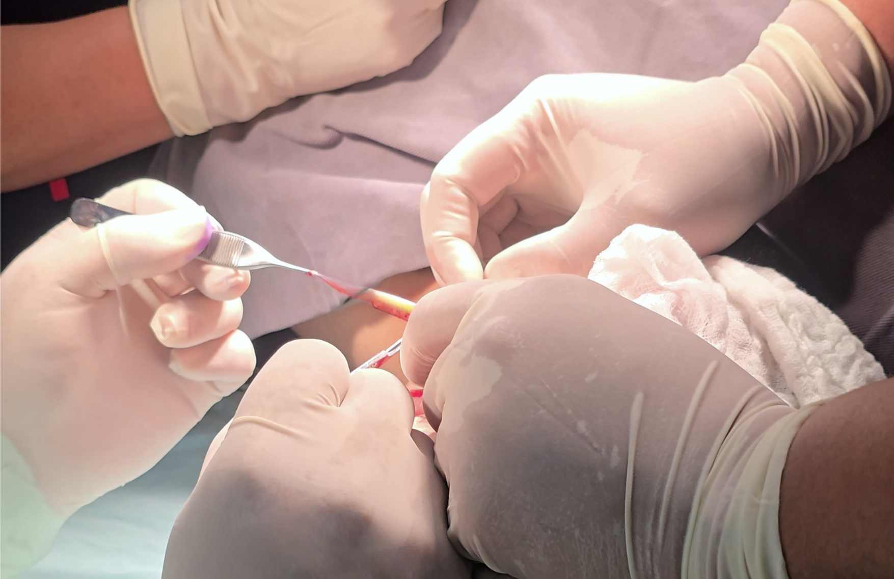 como se realiza la lobuloplastia