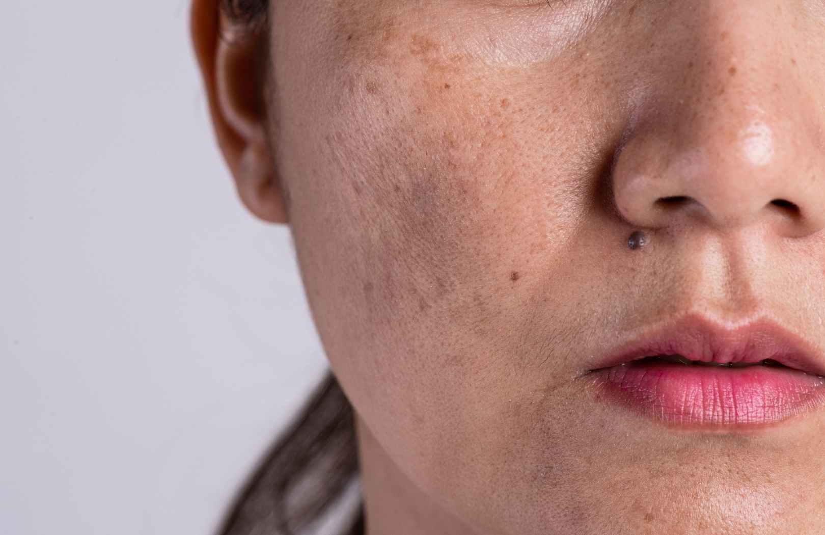como se ve el melasma
