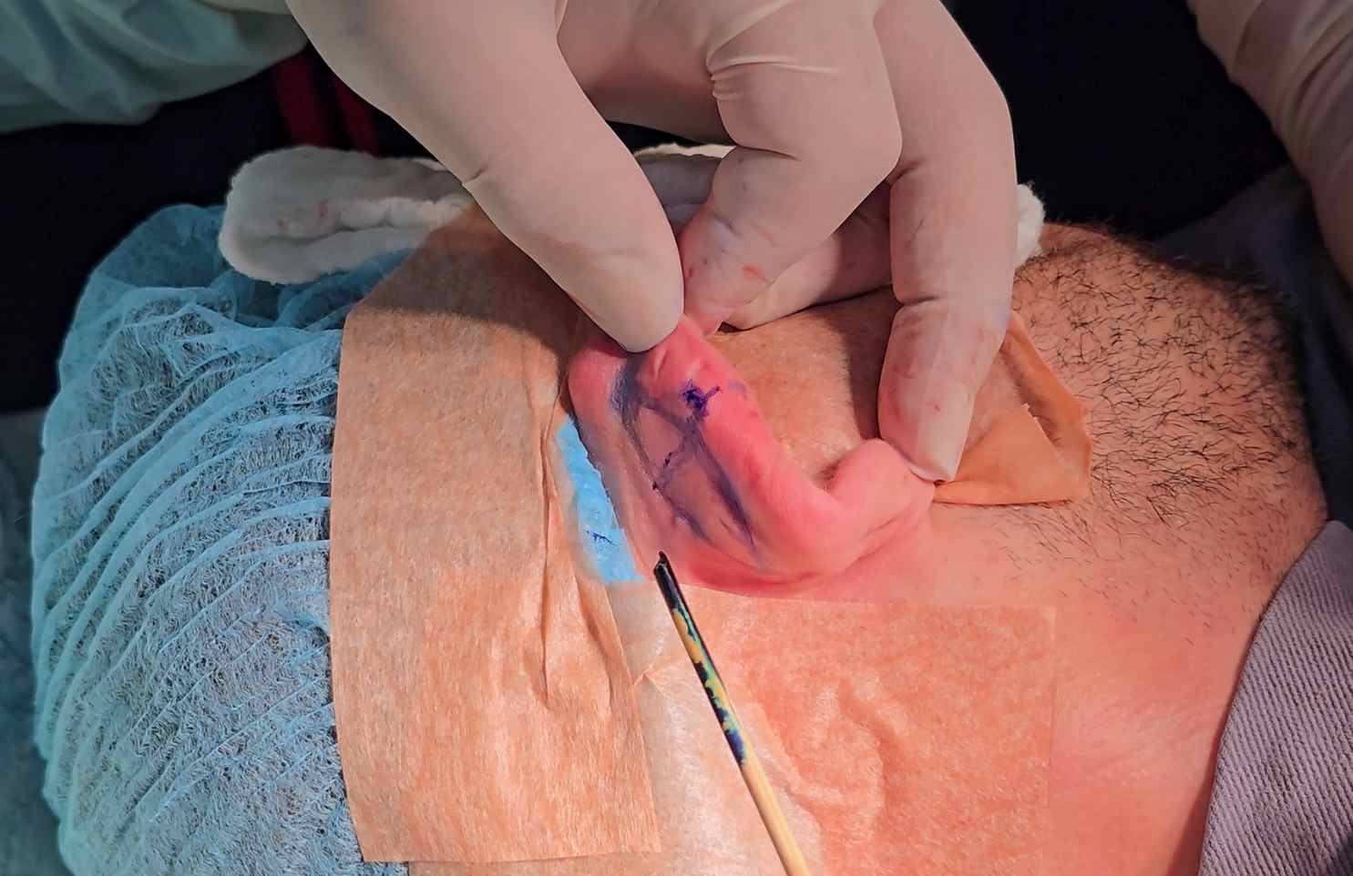 cuando se necesita una otoplastia