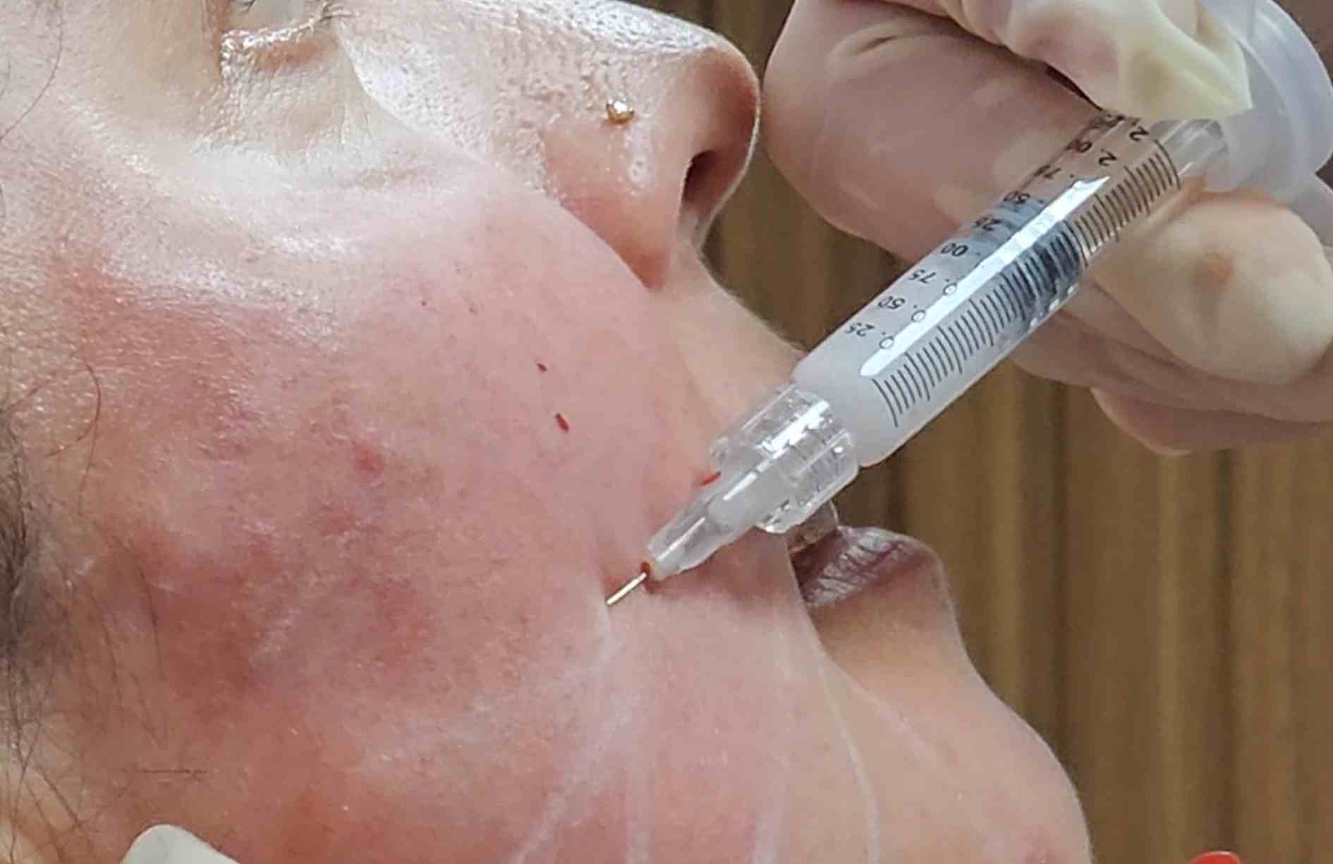 cuanto duran los efectos del radiesse