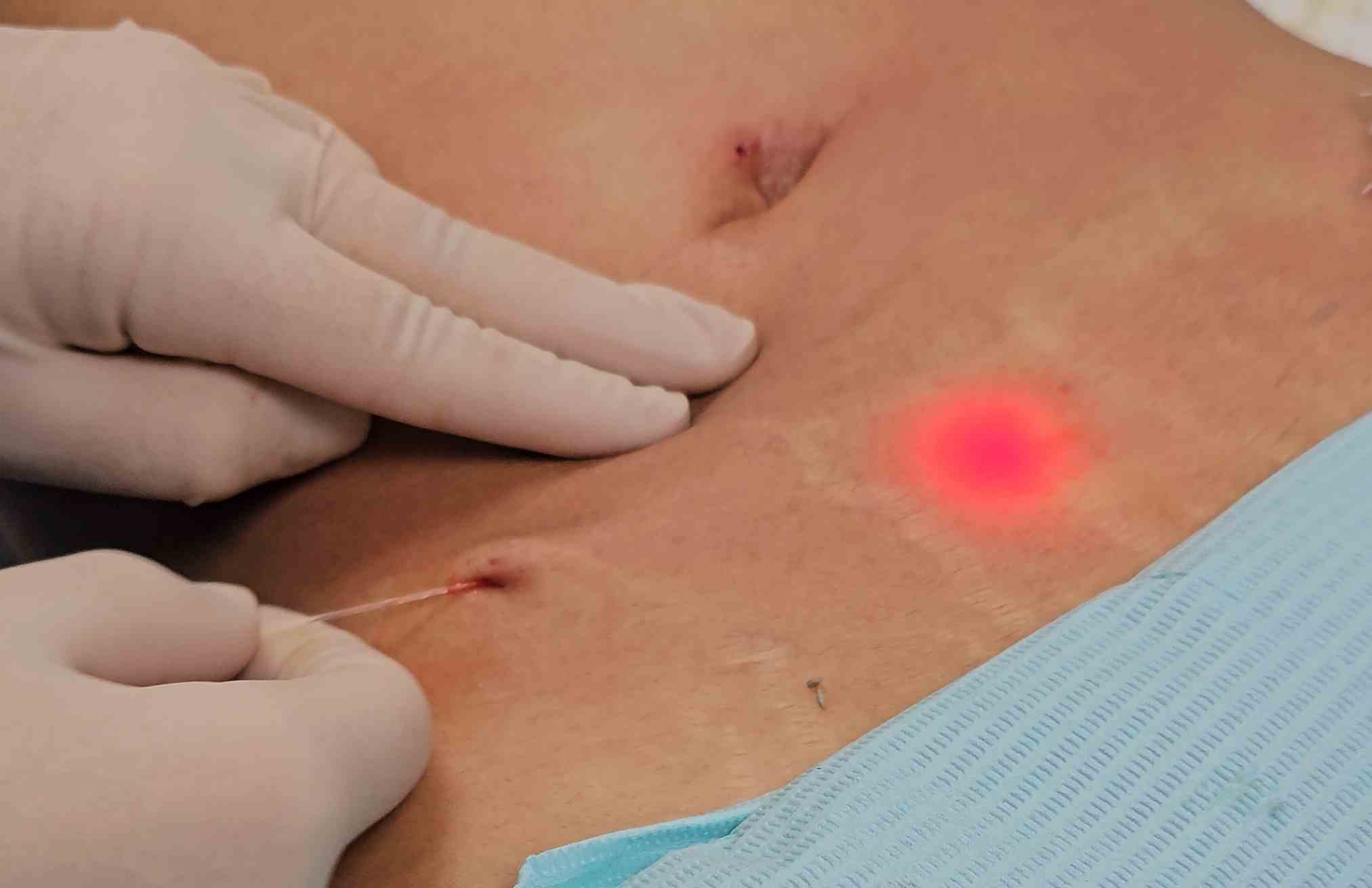 cuidados despues del endolifting laser abdominal