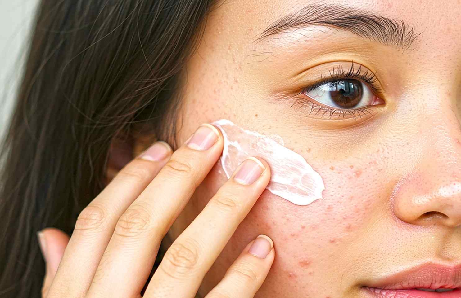 cuidados diarios para prevenir las espinillas