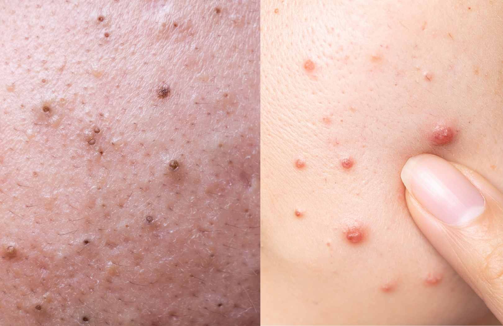 diferencias entre espinillas y granos