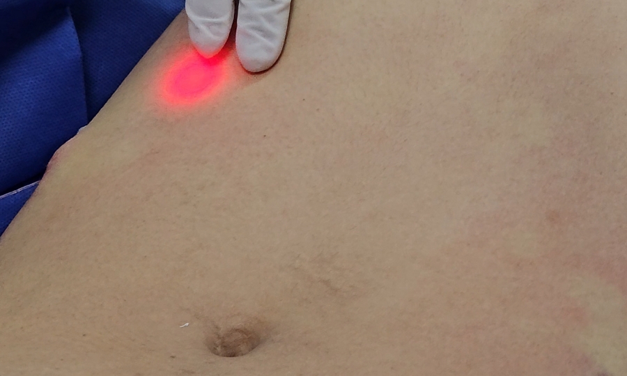 Endolift Abdomen