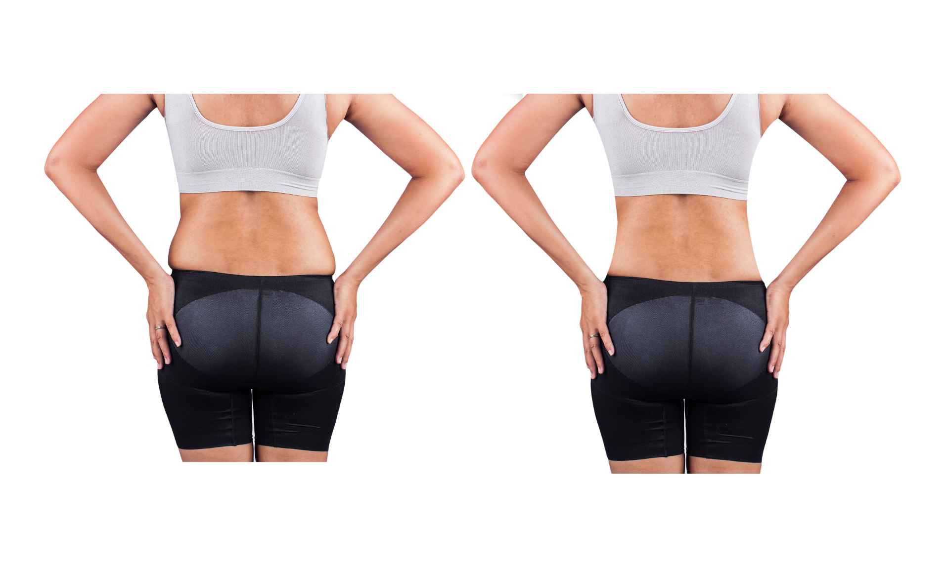 Cuanto duran los efectos de endolifting en abdomen