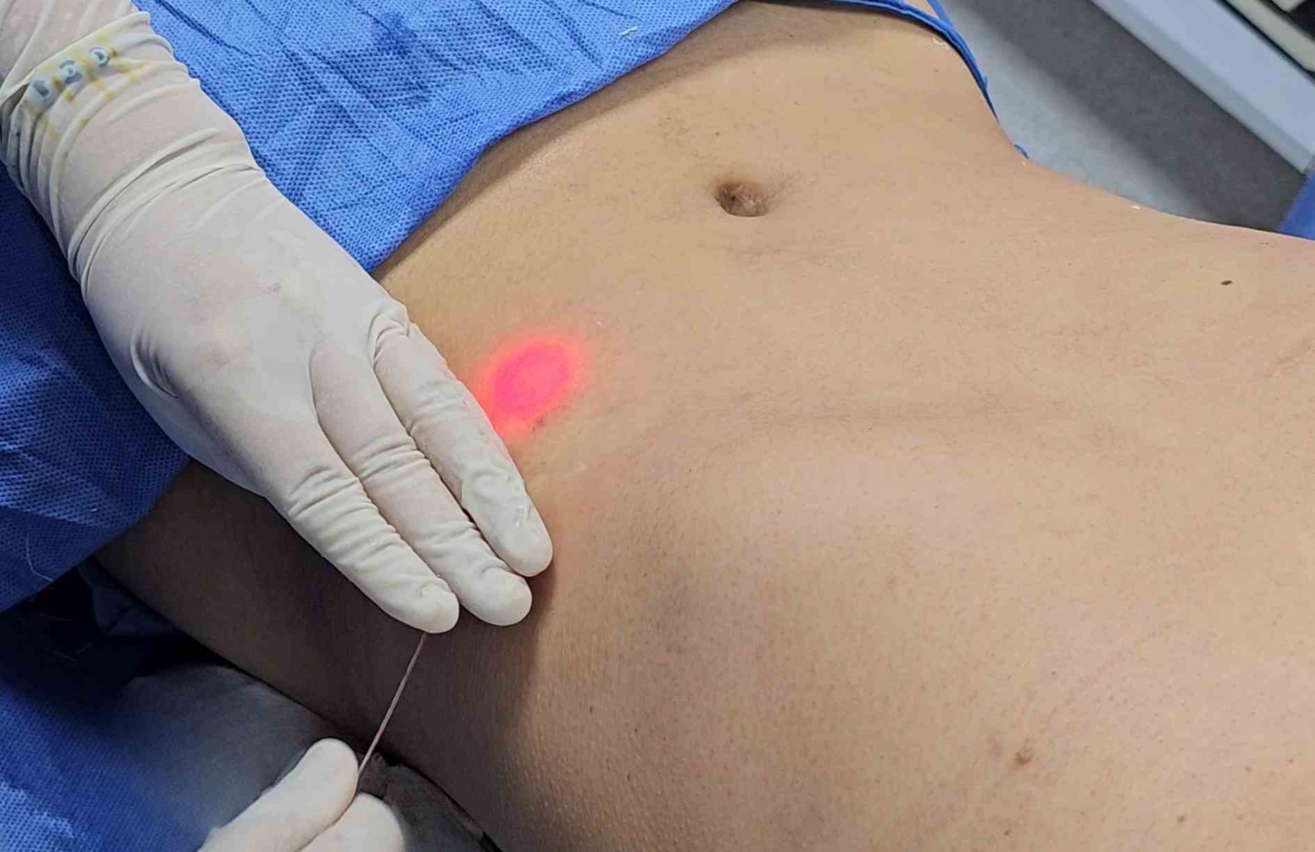 Que es el endolifting laser abdominal
