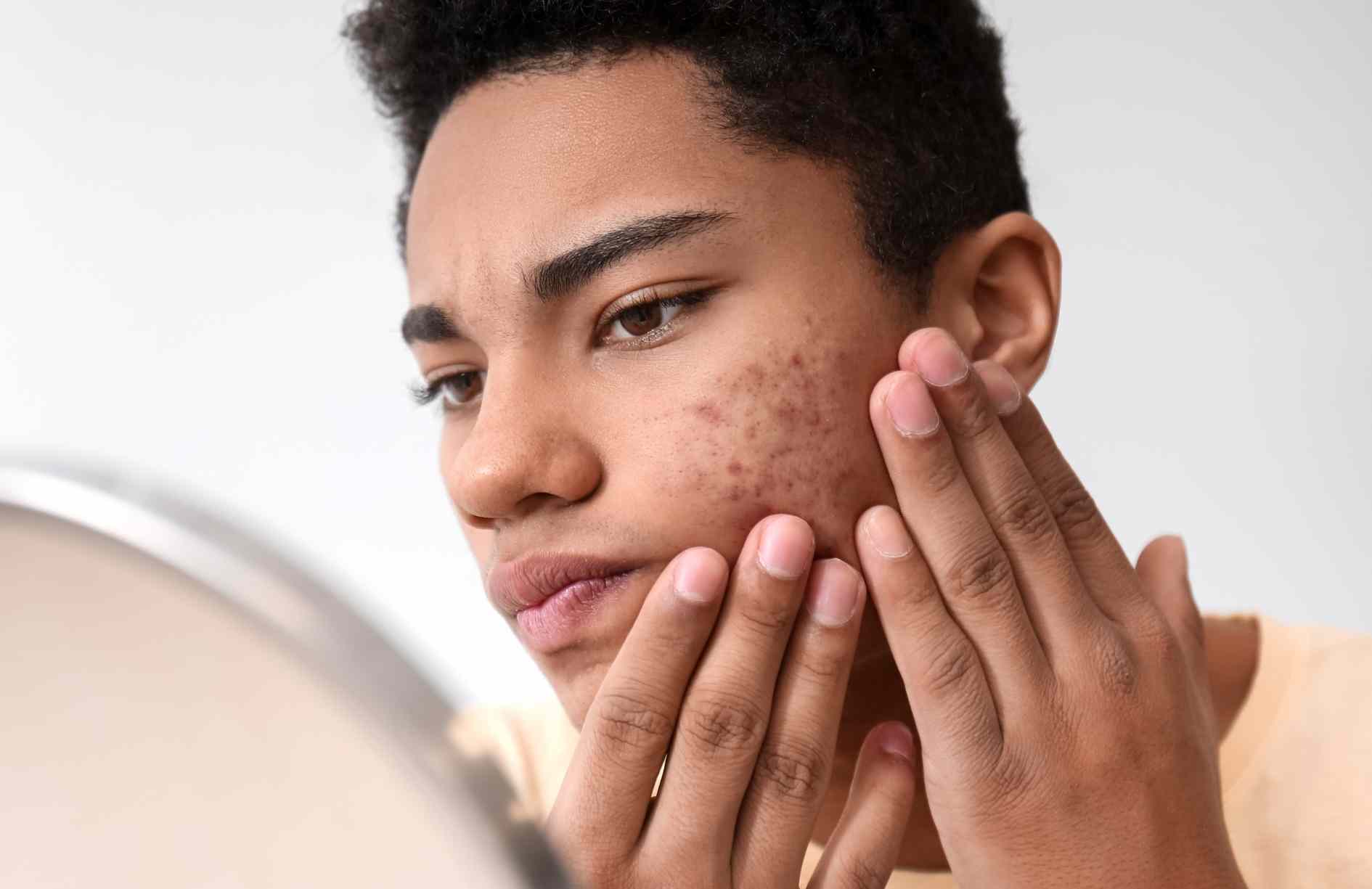 Acido salicílico para las manchas de acné
