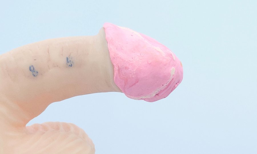 cirugia circuncision