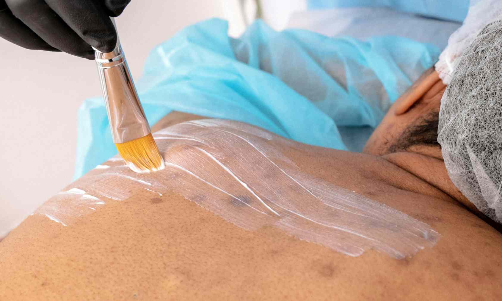 mascarilla para granitos en espalda