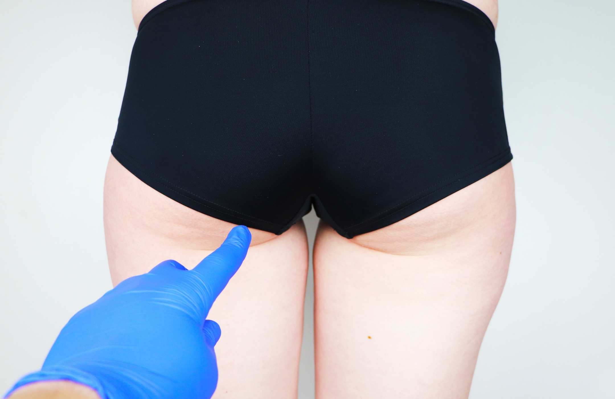 por que se me han caido los gluteos