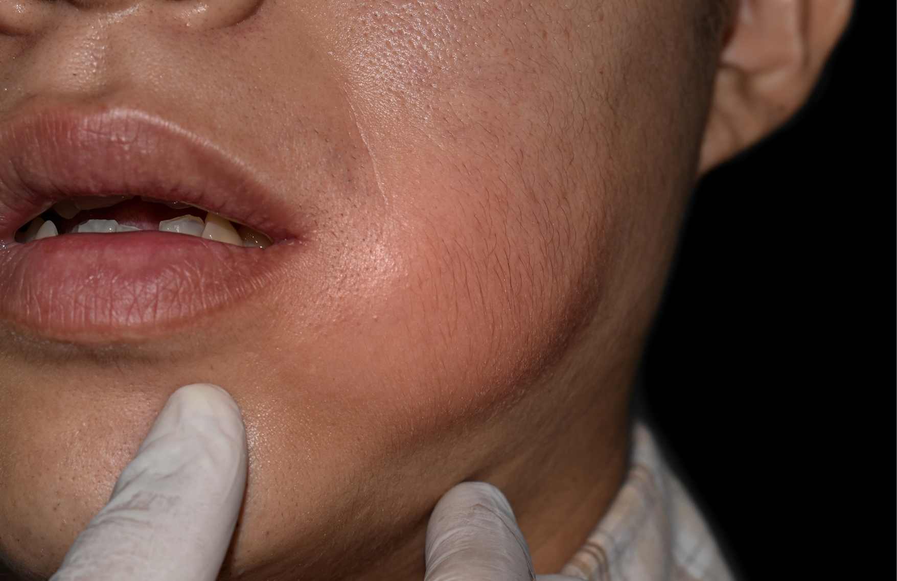 porque salen los abscesos