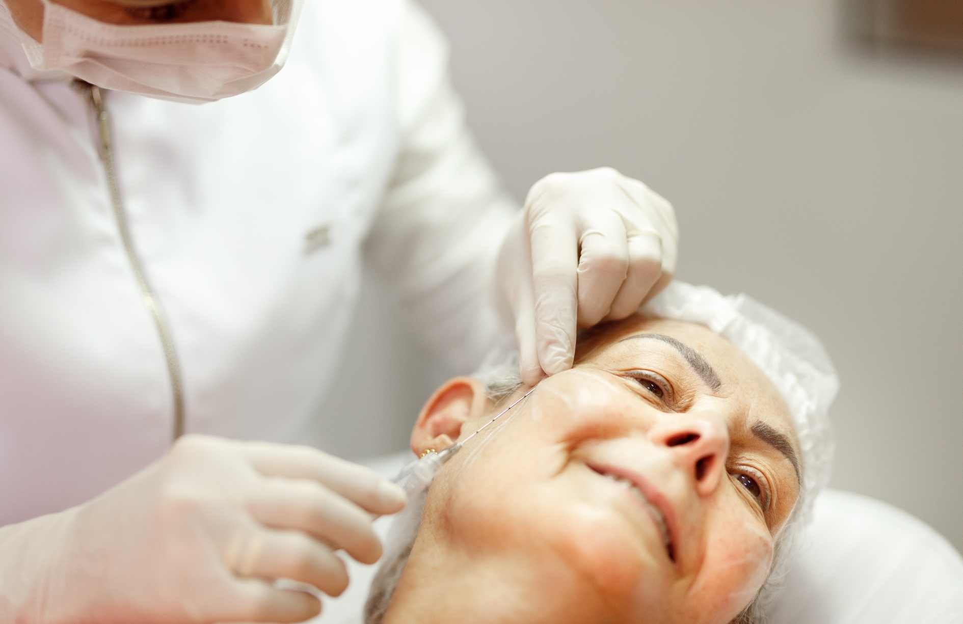 procedimiento de bioestimuladores de colageno