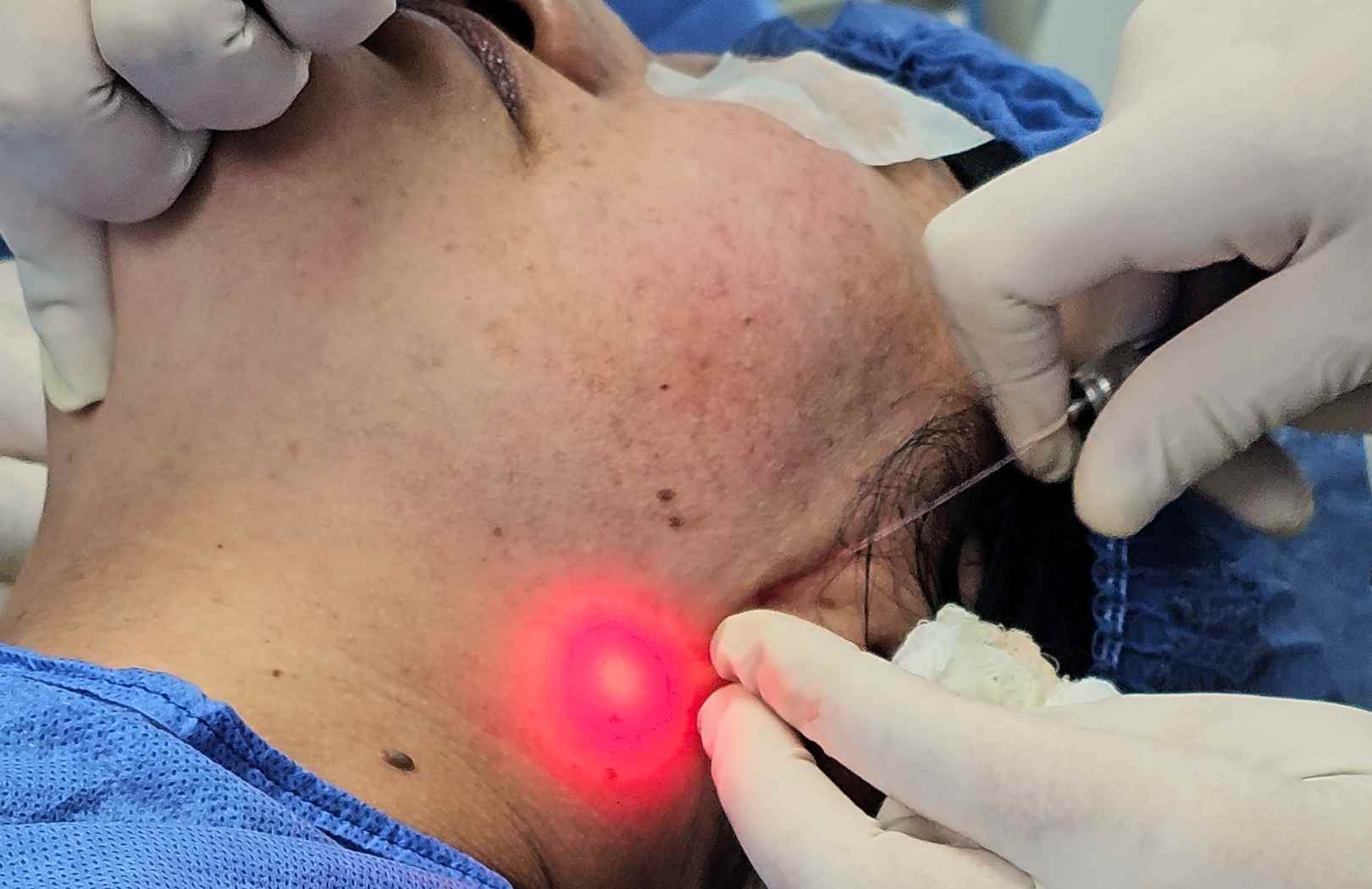 Como es el procedimiento de endolifting en papada