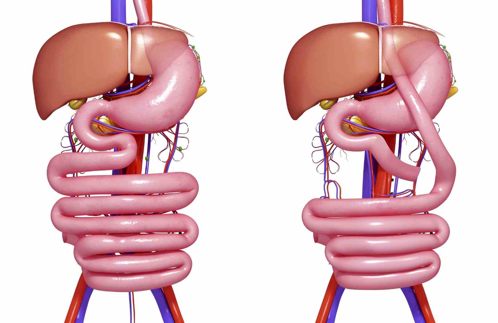 que es bypass gastrico