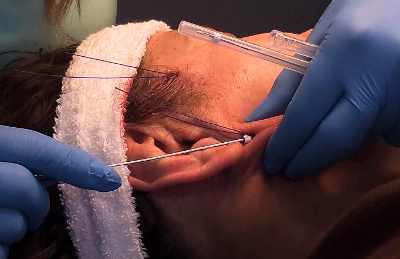 que es el lifting facial sin cirugia