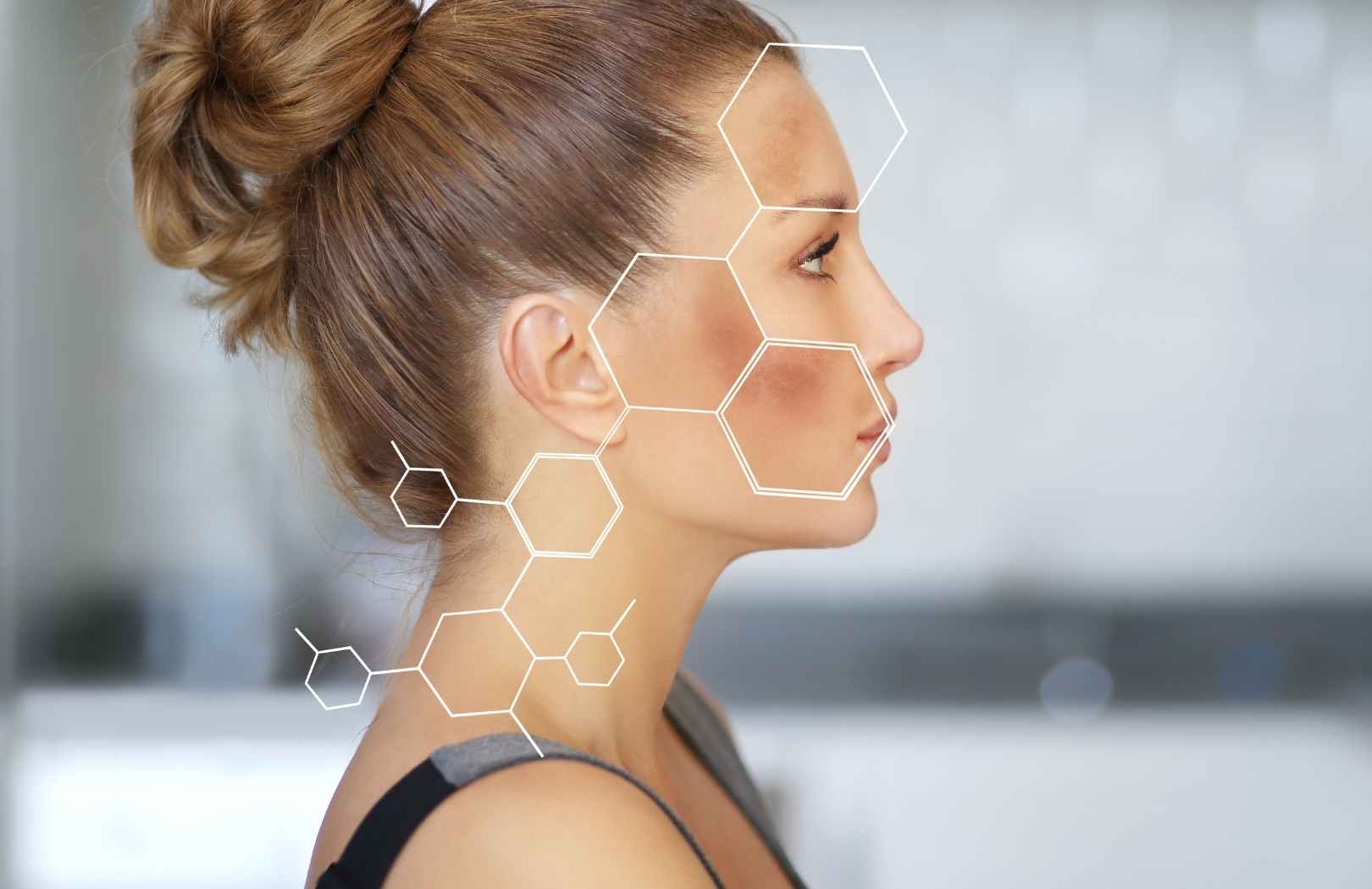 que es el melasma