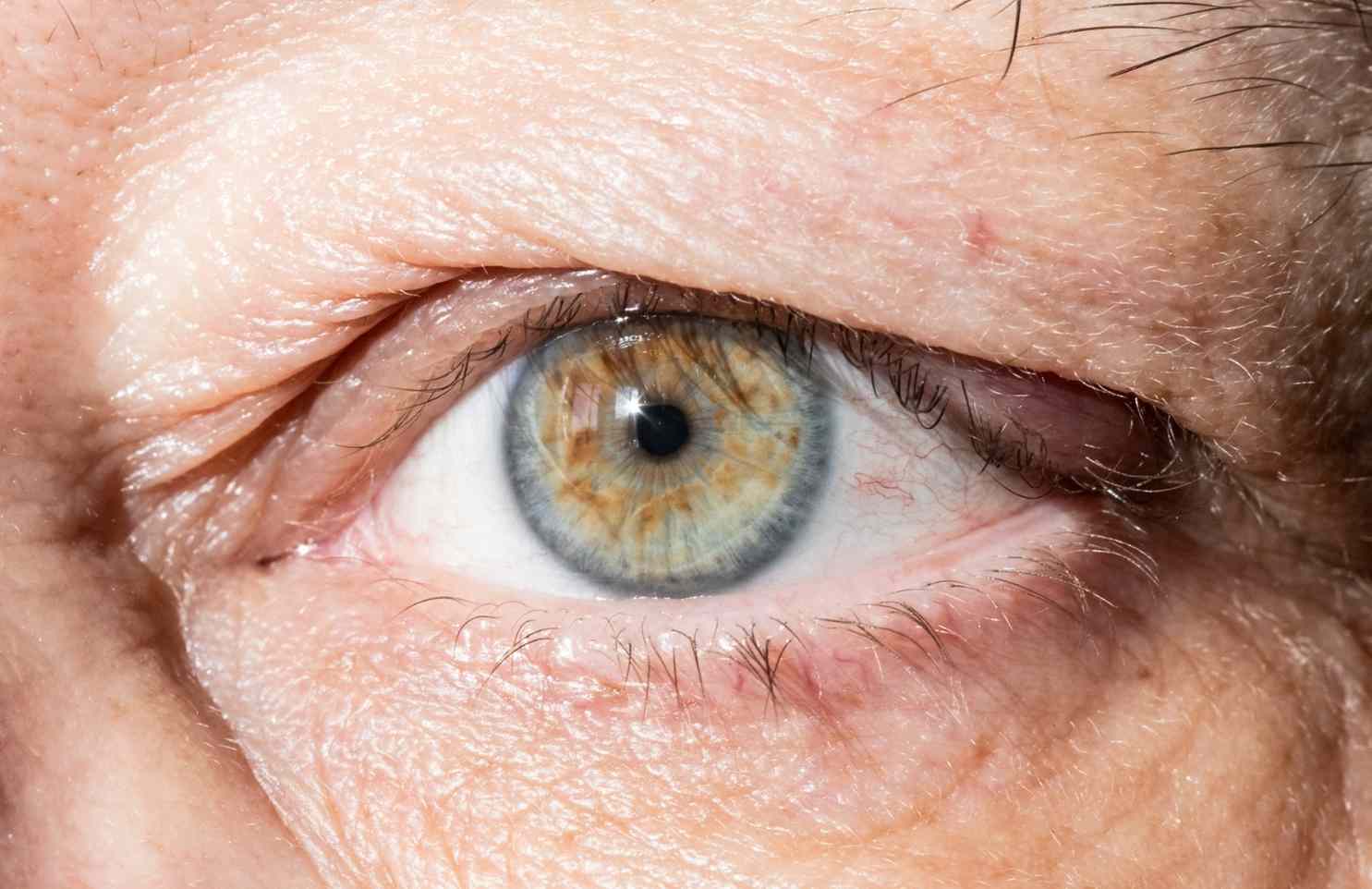 que es el parpado caído