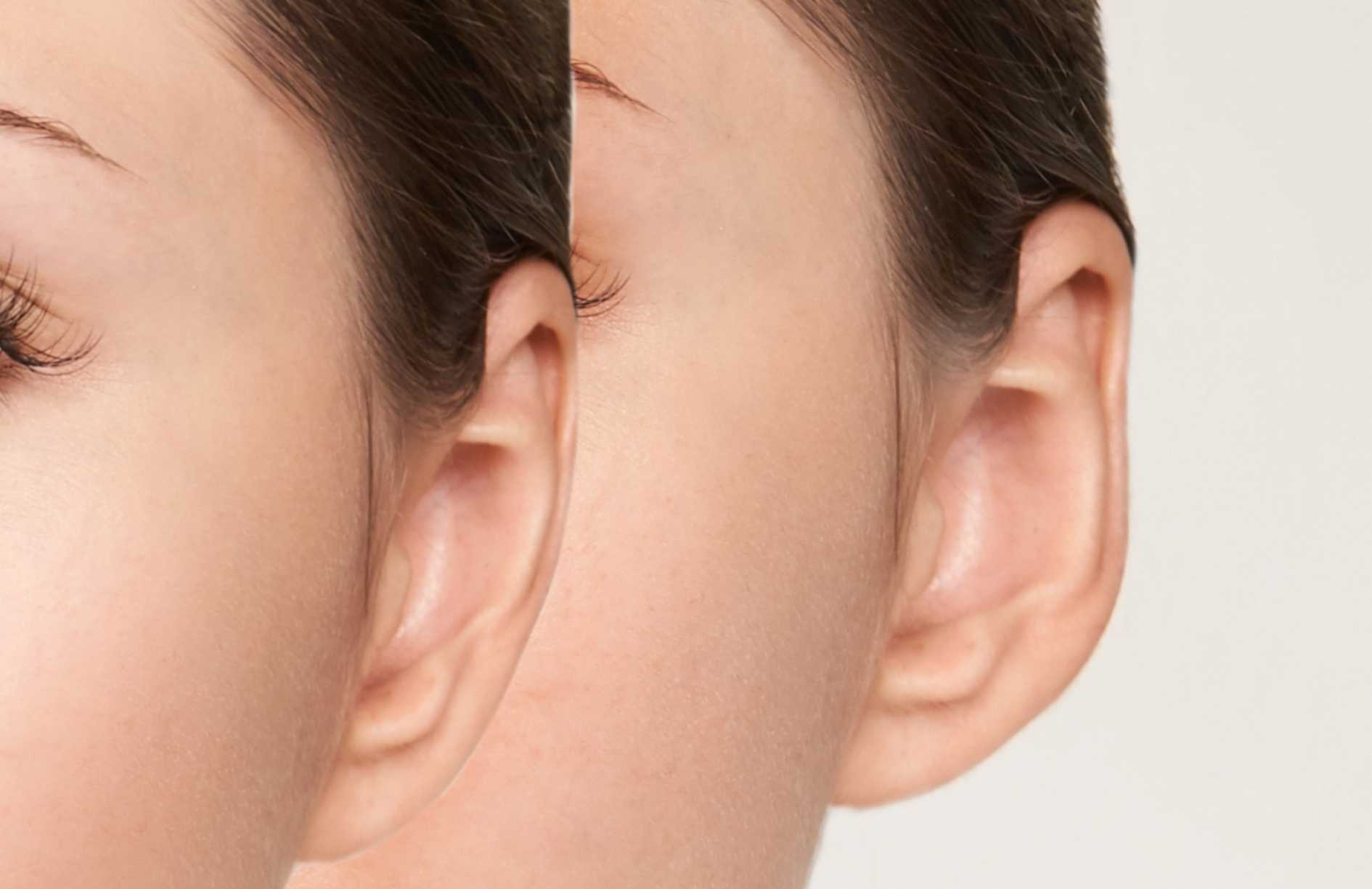 Qué es la otoplastia
