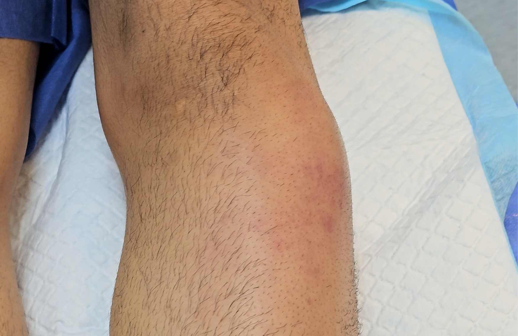 que es un absceso cutaneo