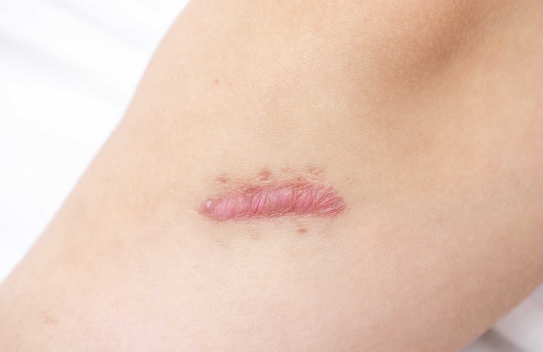 que es una cicatriz queloide