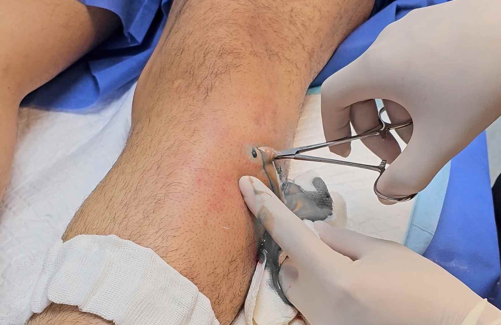 que pasa si no se drena un absceso