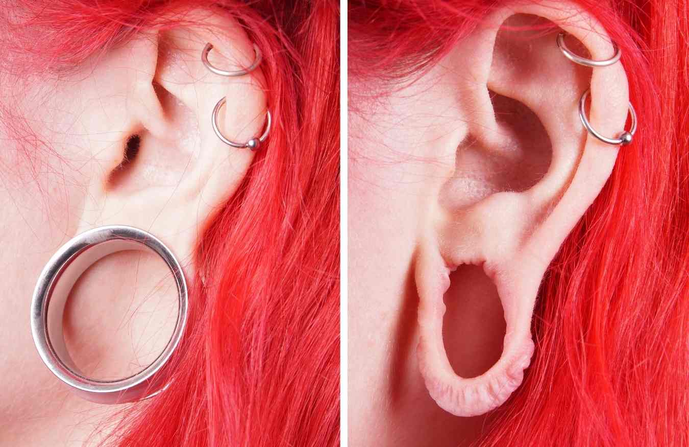 que problemas resuelve la lobuloplastia