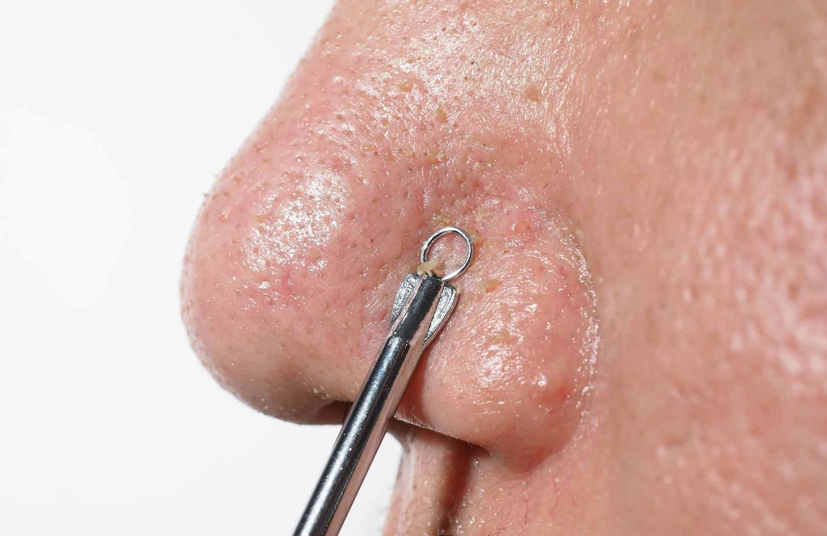 que son las espinillas