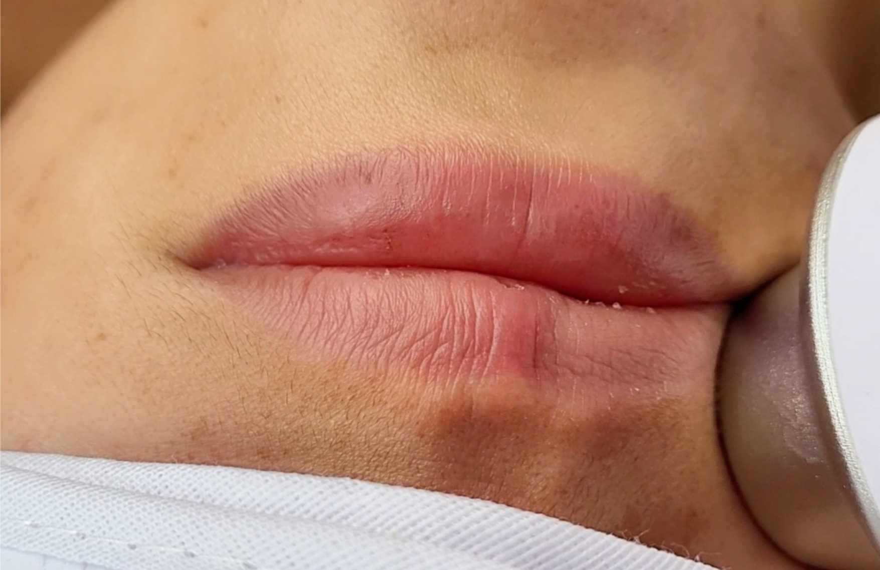 que tan recomendable es depilarse con laser