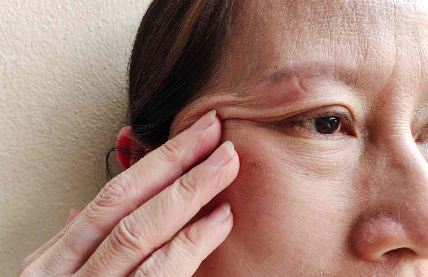 Síntomas del parpado caído