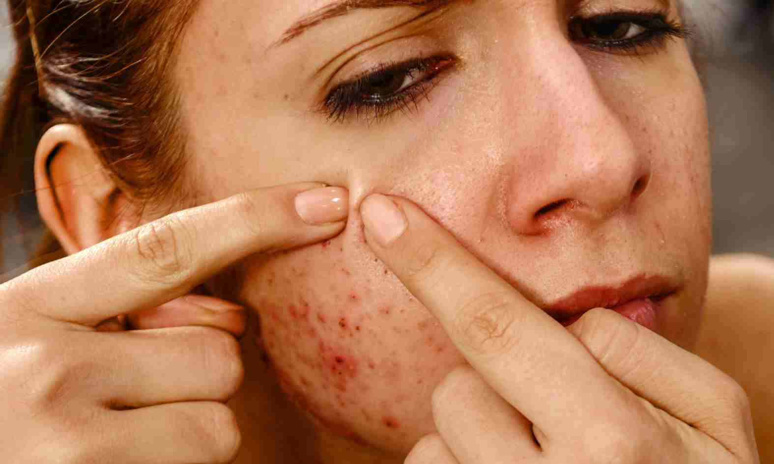 tipos de acne