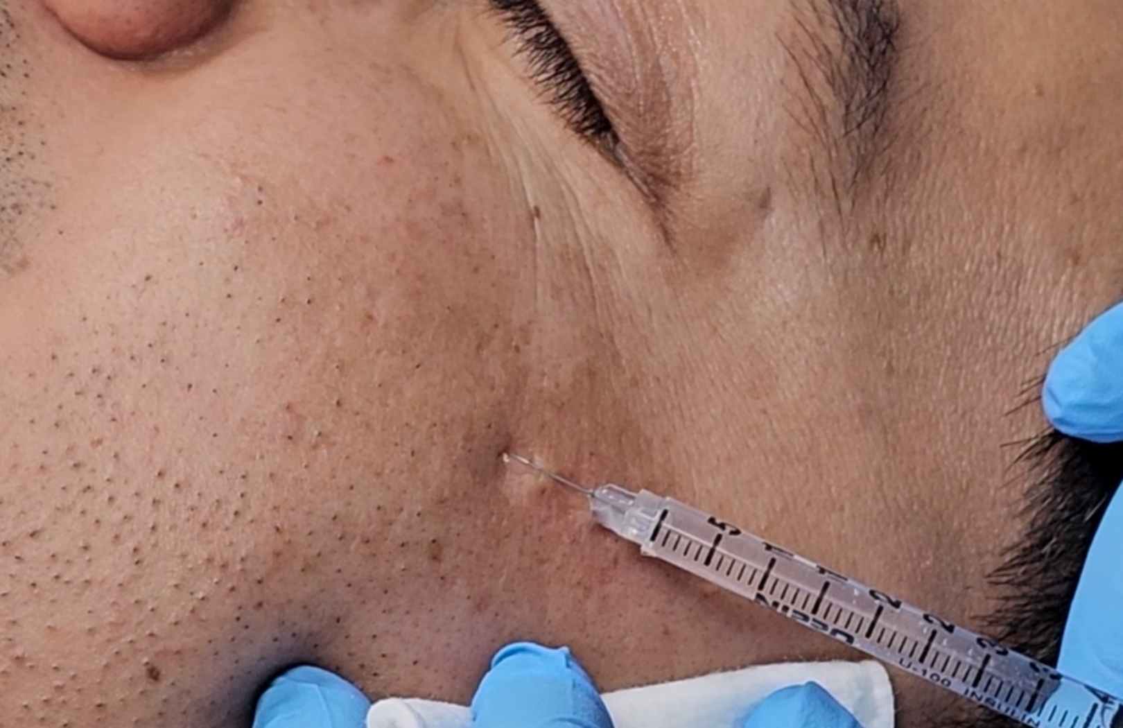 tratamiento para las manchas en la cara