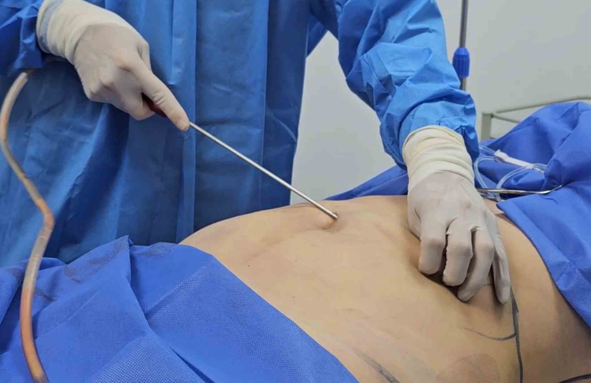 tratamientos alternativos para el endolifting laser abdominal