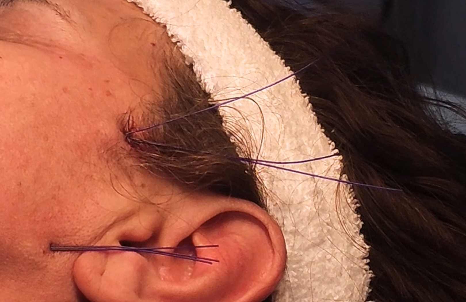 ventajas de lifting facial sin cirugia