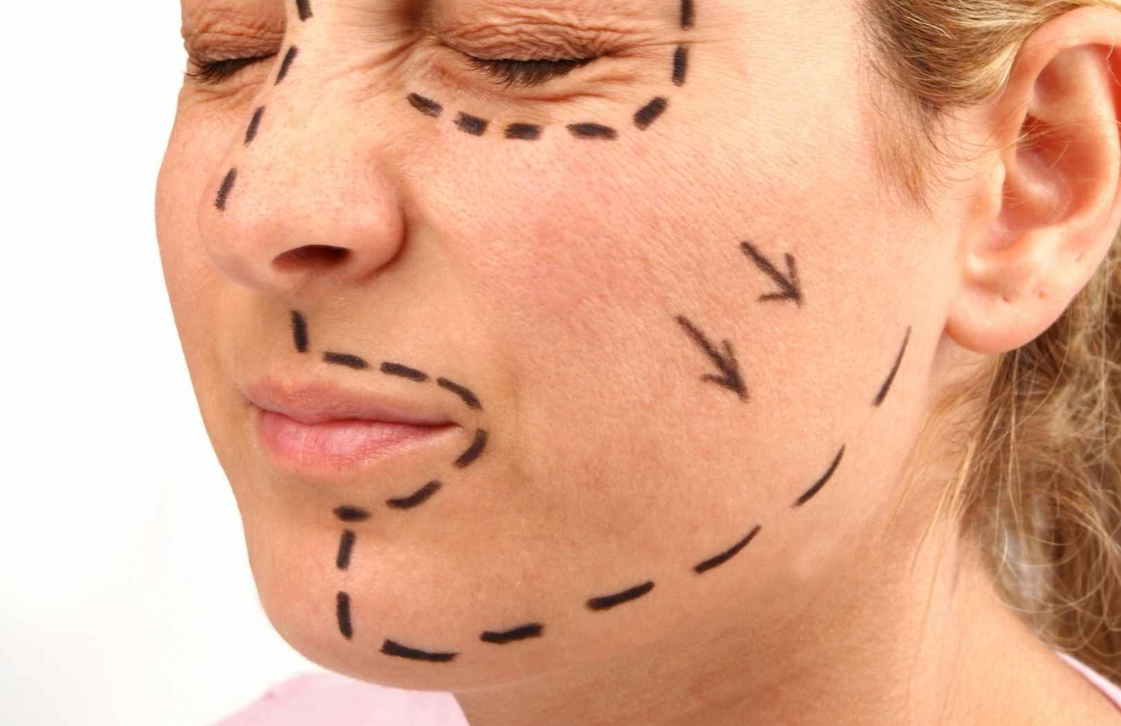 zonas en las que se realiza lifting facial