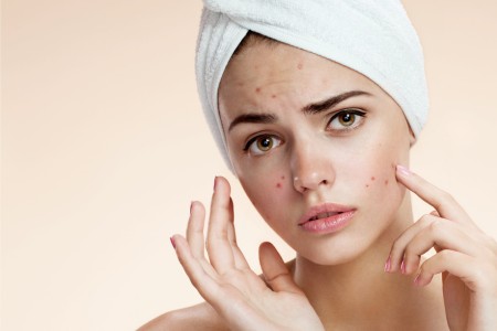 acne causas
