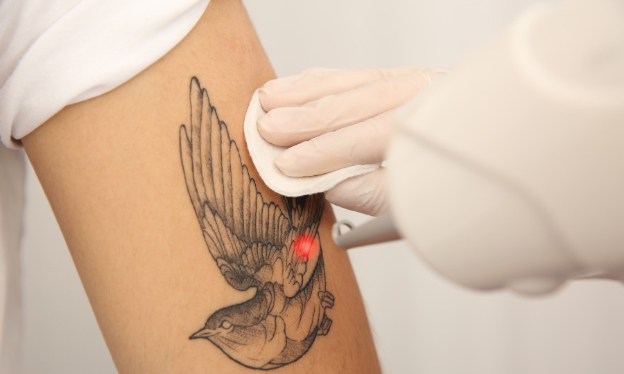 borrar tatuaje dermoabrasion
