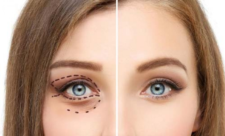 Tratamiento de blefaroplastia sin cirugía o blefarotonificación en Ecuador