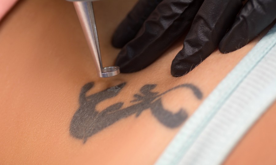 borrar tatuaje dermoabrasion