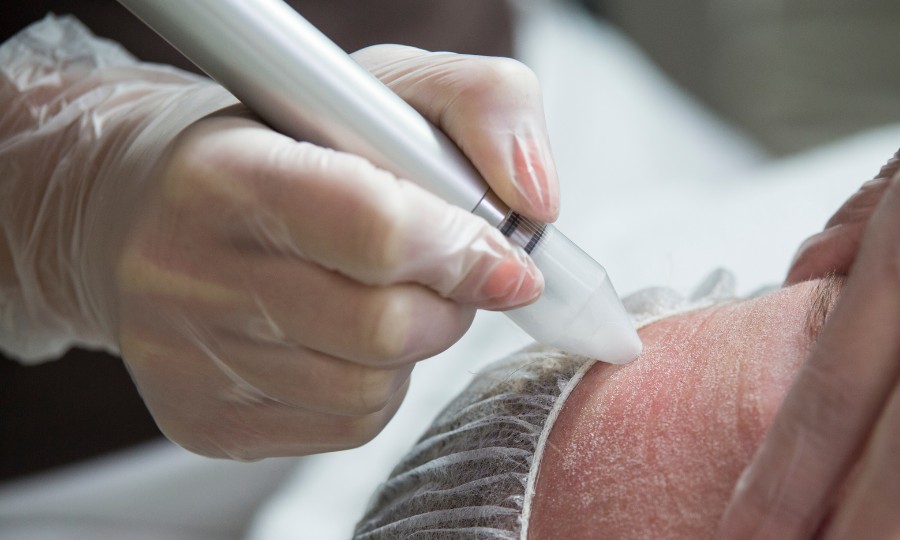 borrar tatuaje dermoabrasion