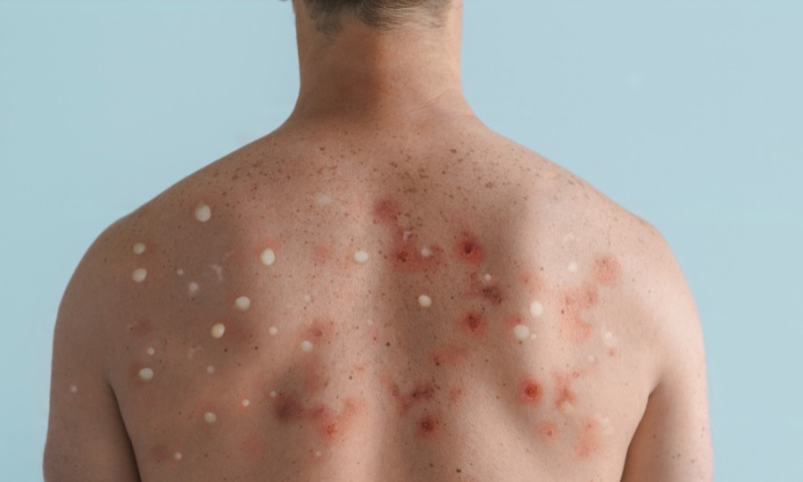 espalda acne corporal